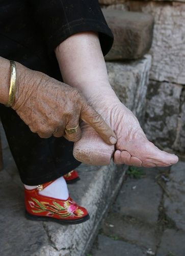 Chinese foot binding – the toes were broken and folded under the foot.