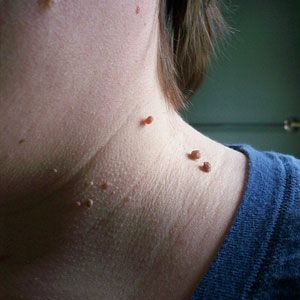 ugly skin tags – home remedies to remove them! (I didn't know you could!!)