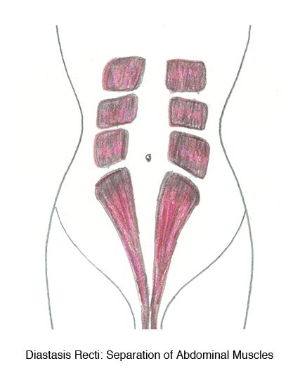 Healing your "mummy tummy" Diastasis Recti: how to heal from having ki