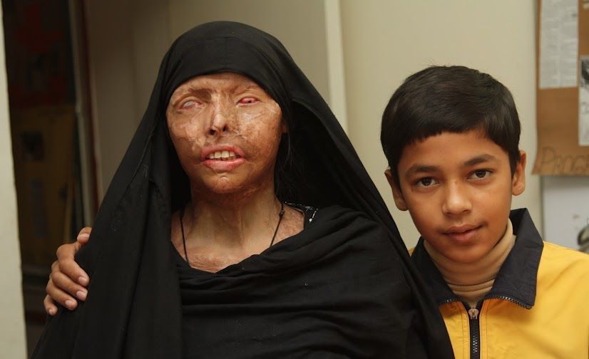 Naeema Azar of Pakistan, shown with her son Ahmed, was disfigured and blinded wh