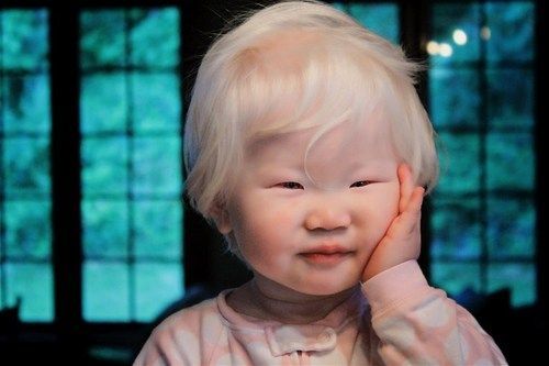Asian girl with albinism