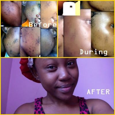 Color Me Beautiful!: Lemon & Sugar Facial Scrub for acne scars