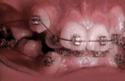 A time lapse of braces straightening teeth: | 36 Gifs Thatll Make You Say “Whoa”