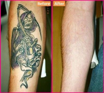 How to Get Rid Of a Tattoo At Home #stepbystep