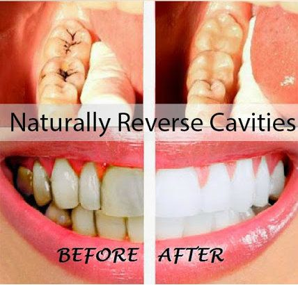 How to Heal Cavities Naturally -   The Best DIY Toothpaste To Reverse Cavities and Maintain An Optimal Oral Health