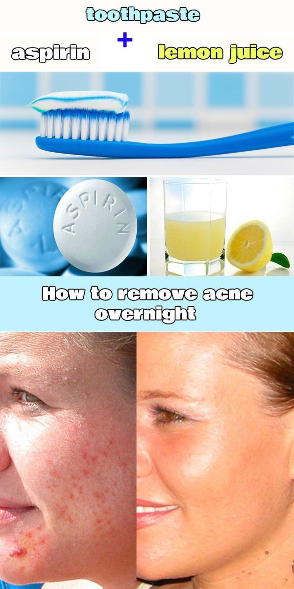 How to remove acne overnight