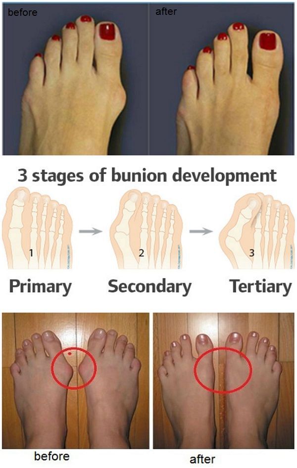 wow!! simple, easy-to-do exercises to remedy or prevent bunions or hammertoes!!! it can even – possibly – help you avoid surgery!