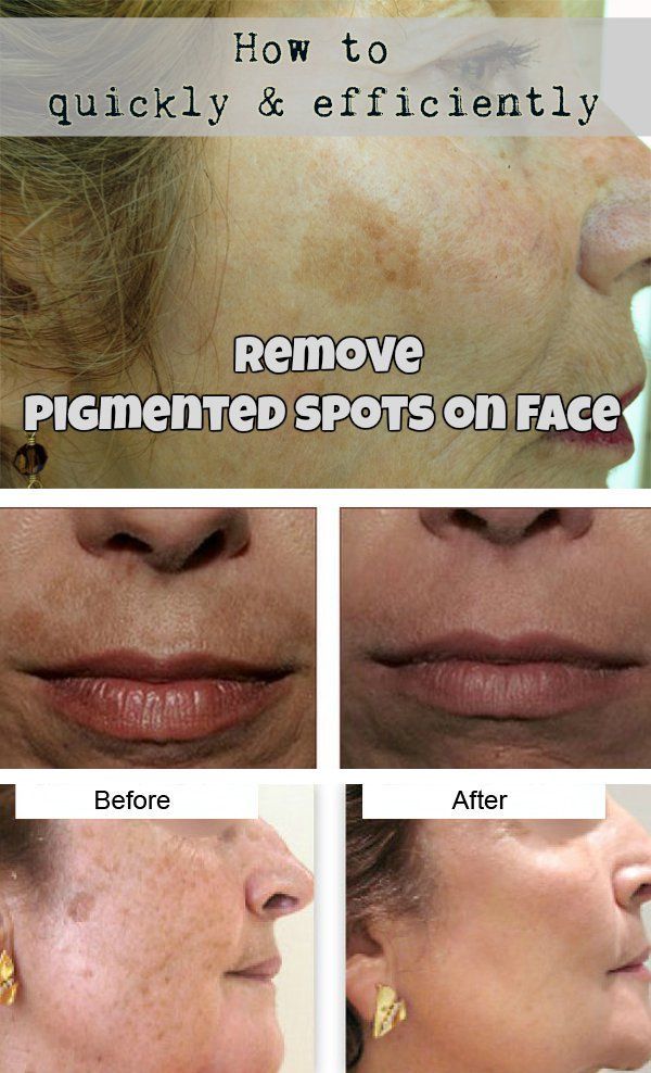 How To Quickly And Efficiently Remove Pigmented Spots On Face