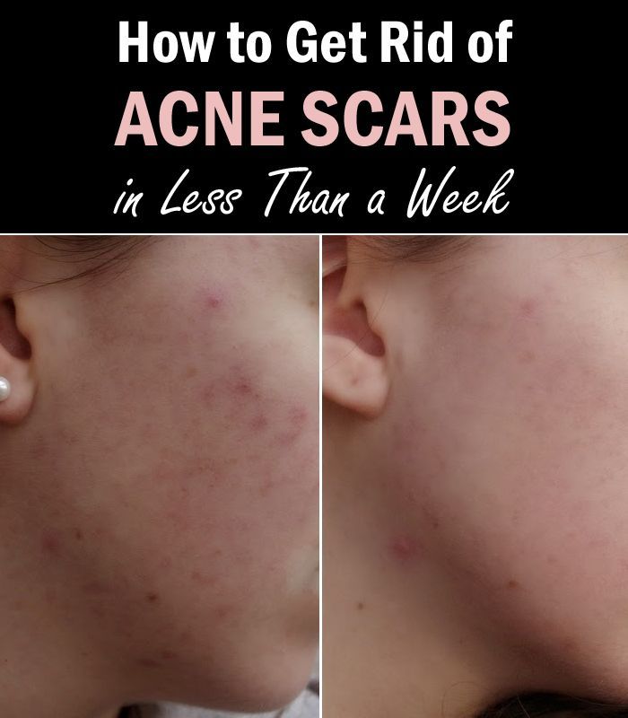 How to Get Rid of Acne Scars in Less Than a Week
