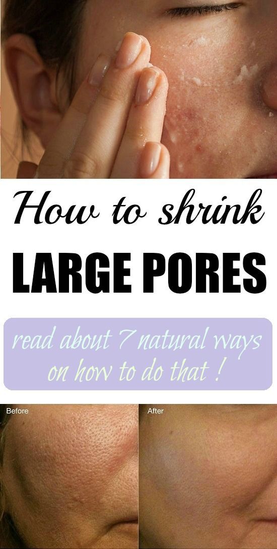 how to shrink large pores