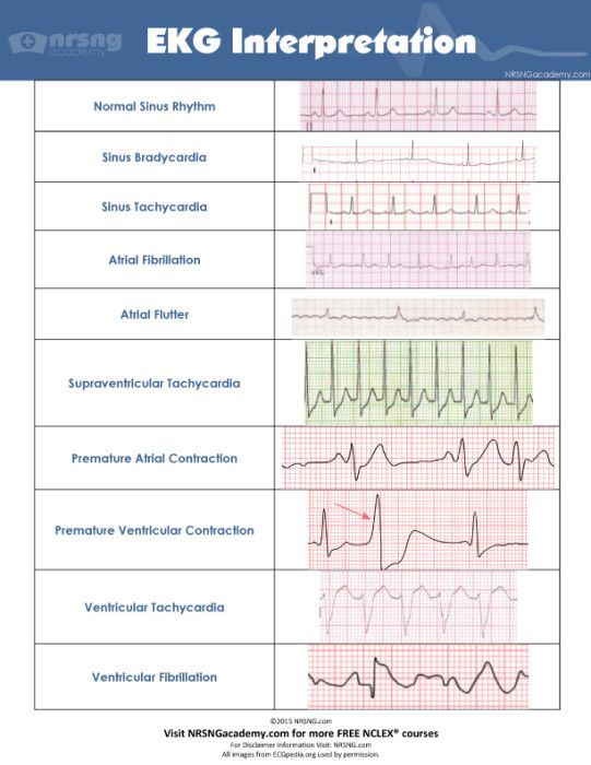 common ecg ekg rhythms