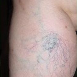 Five Effective Natural Cures For Spider Veins