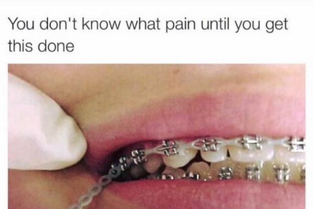 21 Tweets About Having Braces That Are Way Too Real – Lol oh my gosh, it’s so true.