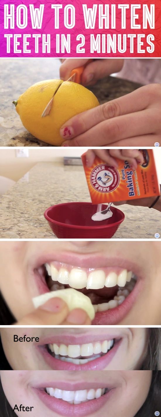 Whiten Your Teeth In 2 Minutes