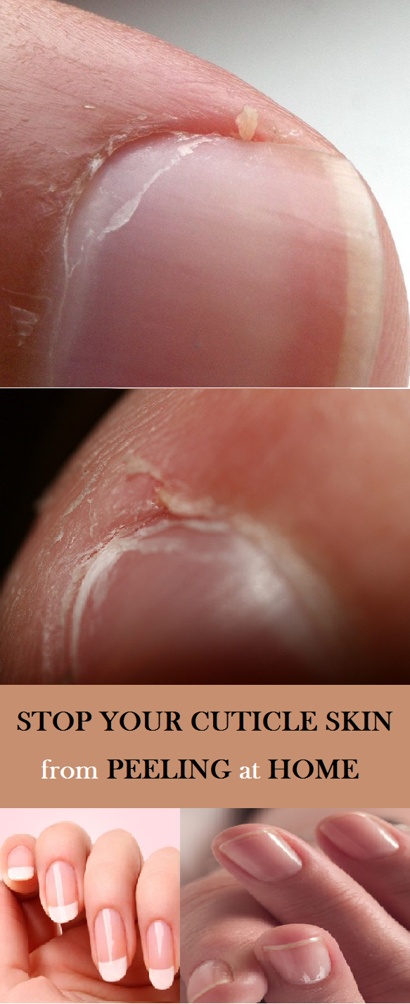 5 Causes and Their Corresponding Treatments of Skin Peeling Around Nails -   Stop Your Cuticle Skin