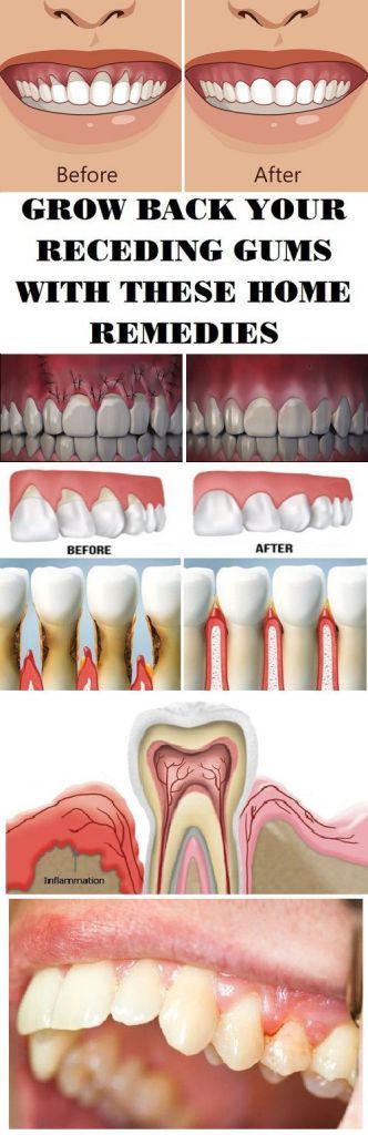 6 Natural Ways To Help Treat Uncomfortable Receding Gums www.kallmeyer-nat… #fitness_logo_weight_loss