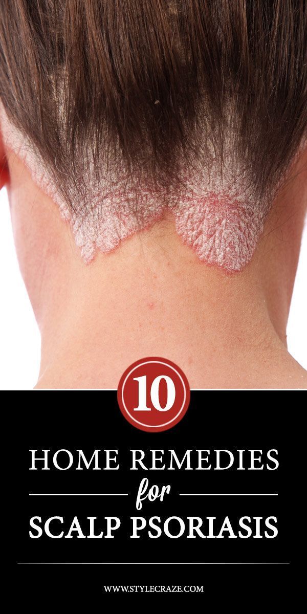 10 Effective Home Remedies For Scalp Psoriasis -   24 thyroid diet home remedies
 ideas