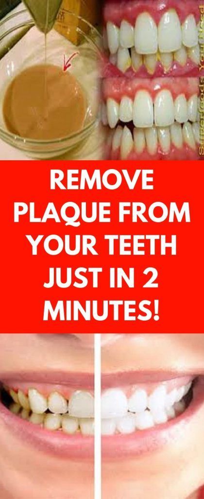 Remove Plaque From Your Teeth Just In 2 Minutes!! -   21 health and wellbeing
 ideas