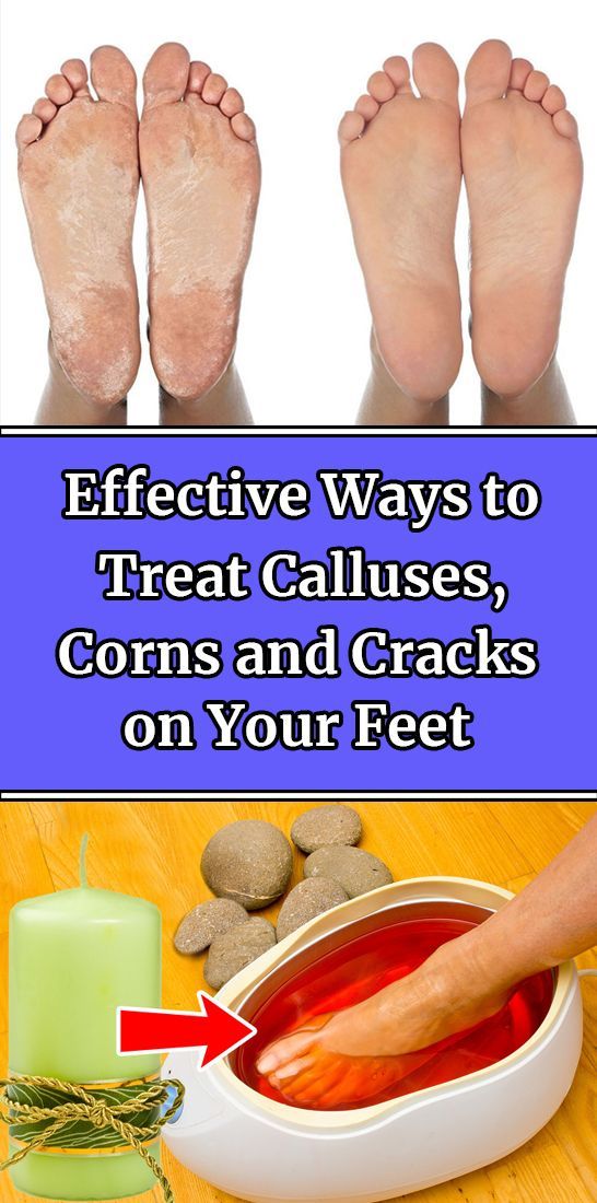 Effective Ways to Treat Calluses, Corns and Cracks on Your Feet -   21 health and wellbeing
 ideas