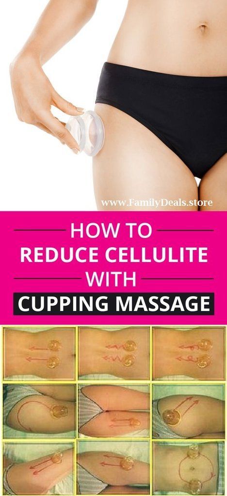 Remove Cellulite - ANTI-CELLULITE VACUUM CUP -   5 3 day lost
 ideas