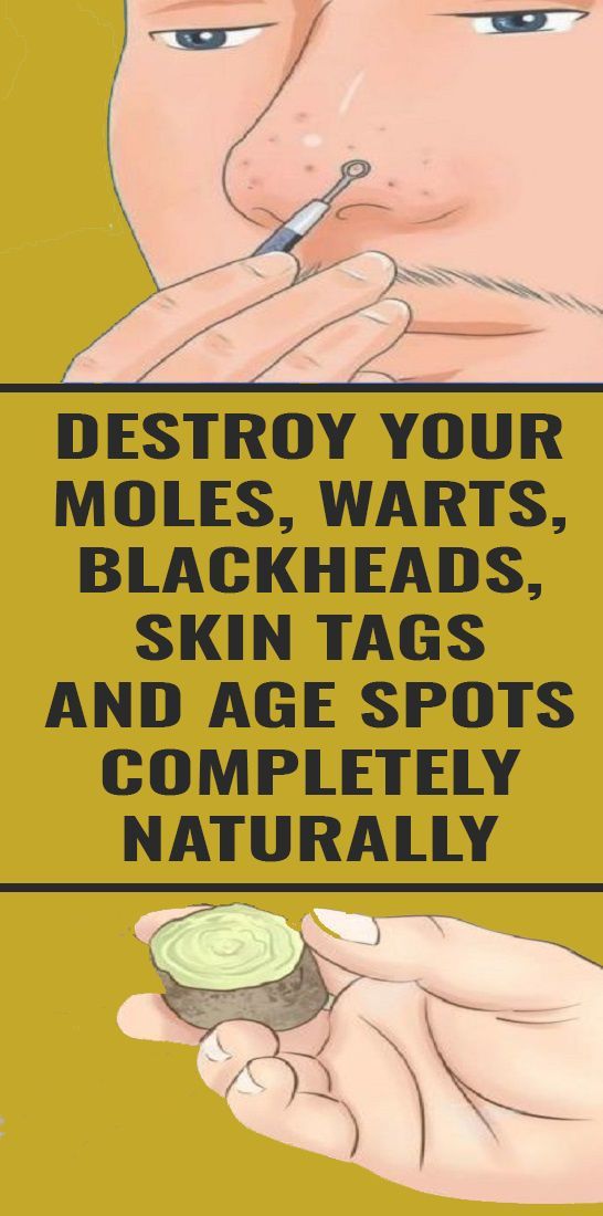 Here's How To Naturally Cure Age Spots, Moles, Skin Tags, Warts, And Blackheads -   10 makeup Beauty remedies ideas