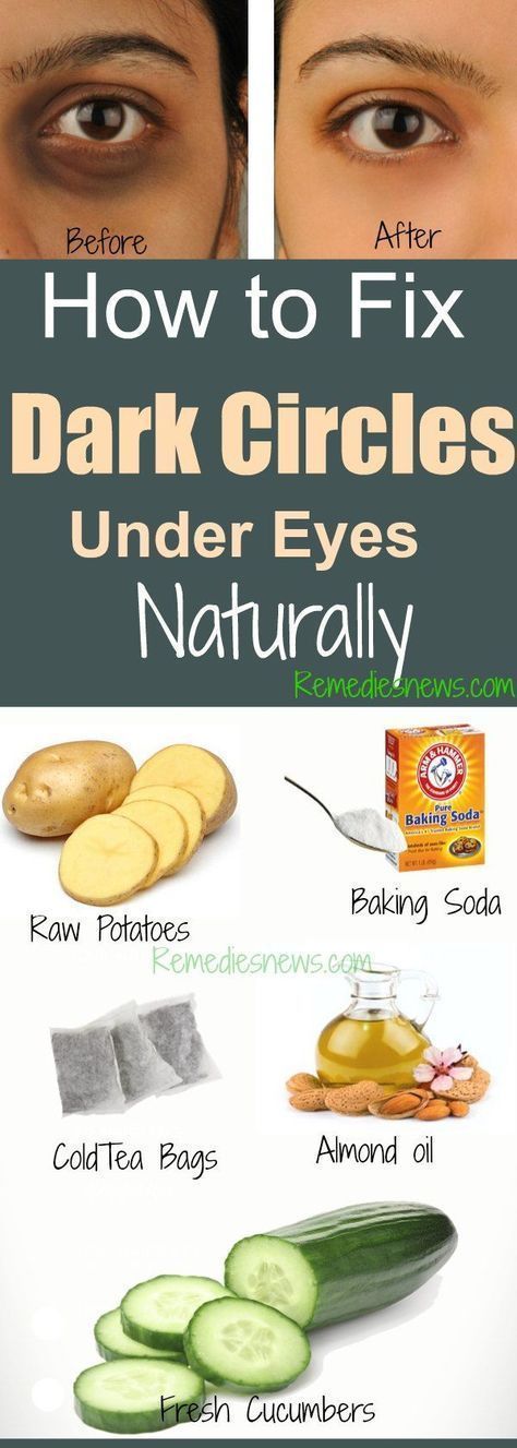 How to Fix Dark Circles Under Eyes Naturally at Home -   10 makeup Beauty remedies ideas