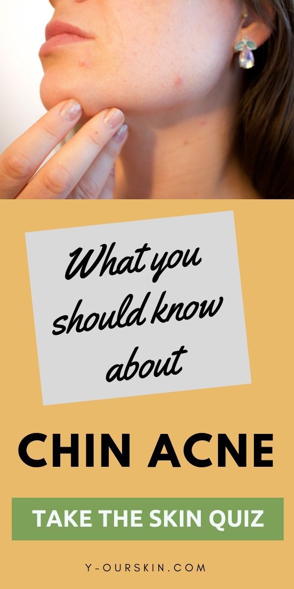 What you need to know about chin acne - Take our skin quiz to find the best regimen for hormonal acne. -   17 skin care Acne types of
 ideas