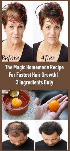 The Magic Homemade Recipe For Fastest Hair Growth! 3 Ingredients Only -   18 hair Growth recipes
 ideas