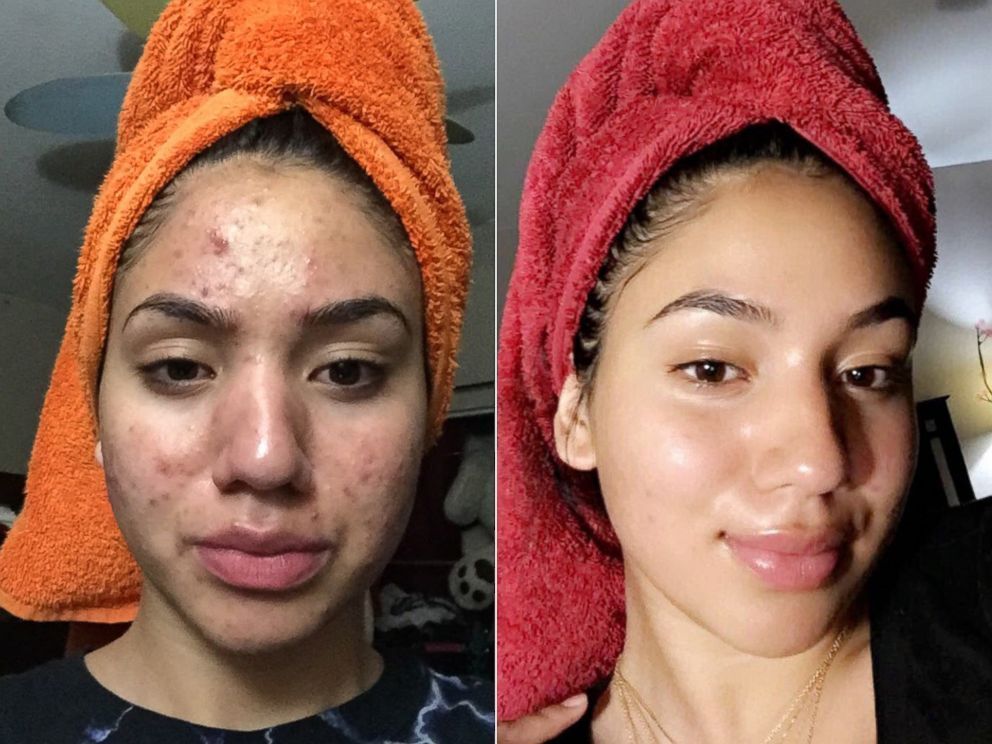 Teen shares how she cleared her severe acne using cheap products -   15 neutrogena skin care Routine
 ideas
