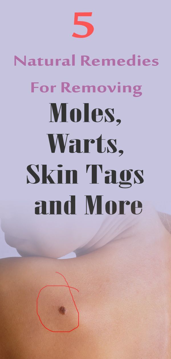 5 NATURAL REMEDIES FOR REMOVING MOLES, WARTS, SKIN TAGS AND MORE -   7 skin care Quotes home remedies ideas