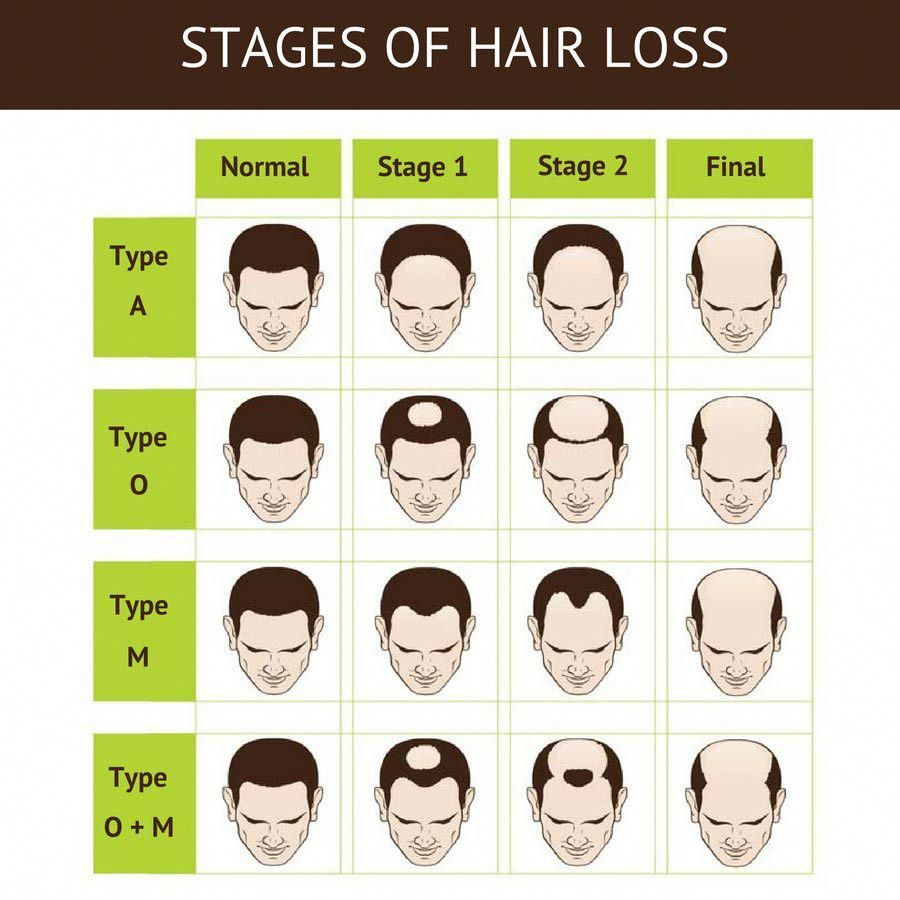 14 Natural Hair Loss Treatments for Men (Backed by Science) -   13 hair Men natural ideas
