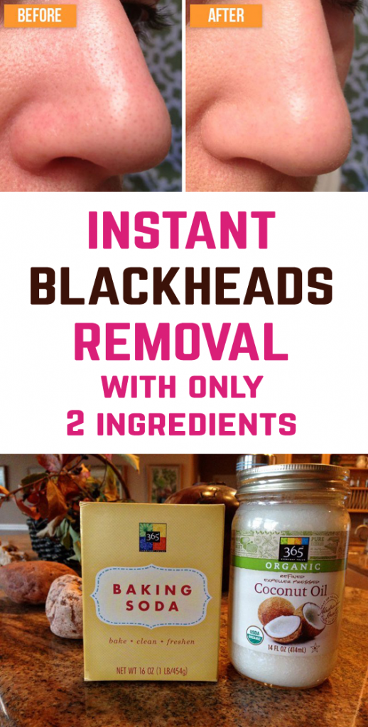 Say Goodbye to Blackheads on Your Face With Only 2 Ingredients -   13 skin care Acne homemade ideas