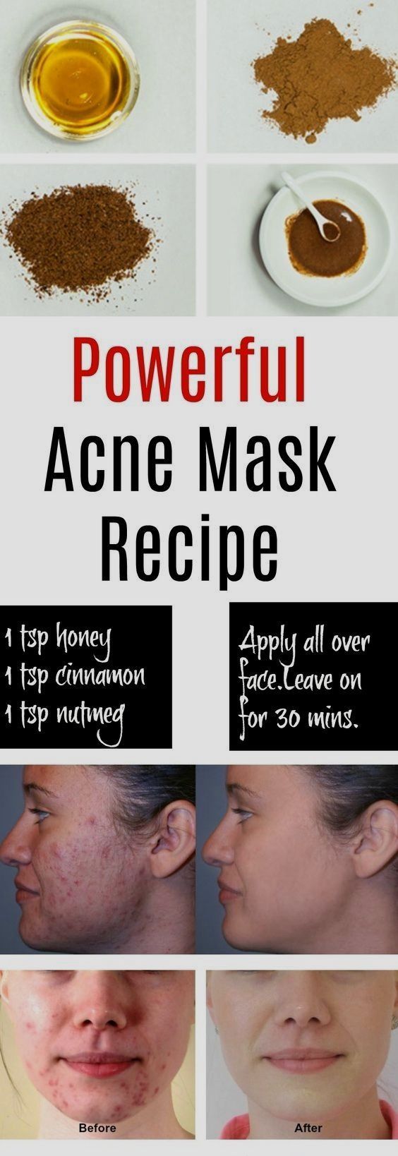 Skin Care Tips For Beautiful Skin -   13 skin care Acne homemade ideas