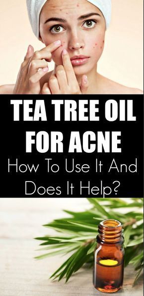 Tea Tree Oil for Acne: How to Use it and Does it Help? -   13 skin care Acne tea tree ideas