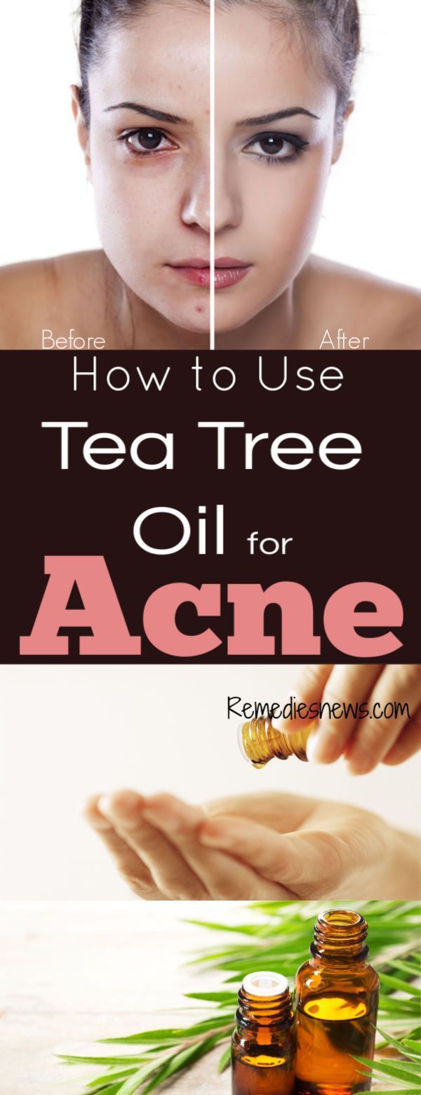 How to Use Tea Tree Oil for Acne : 11 Powerful Tea Tree Oil Recipes -   13 skin care Acne tea tree ideas
