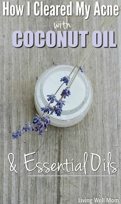 How I Cleared My Acne with Coconut Oil & Essential Oils -   16 makeup Noche coconut oil ideas
