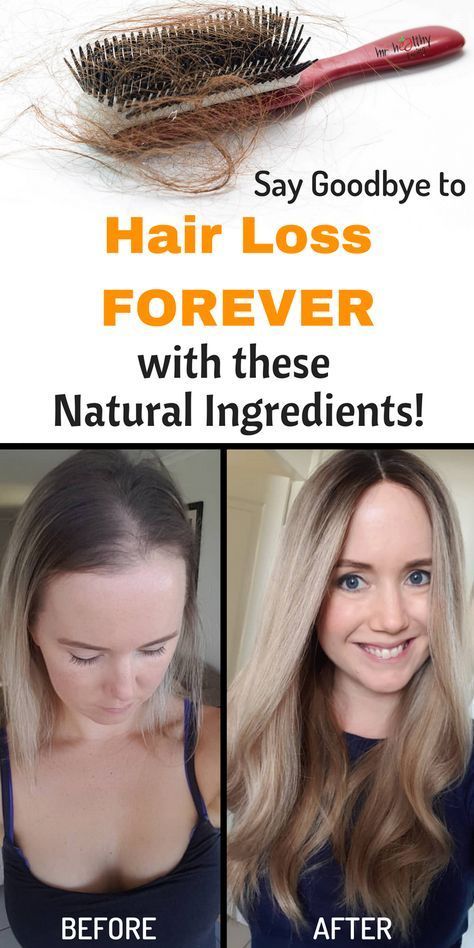 Say goodbye to Hair Loss forever with these Natural Ingredients! -   17 thinning hair Women ideas