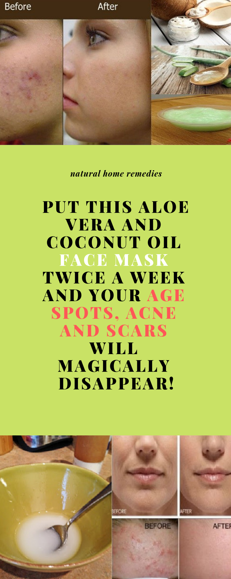 PUT THIS ALOE VERA AND COCONUT OIL FACE MASK TWICE A WEEK AND YOUR AGE SPOTS, ACNE AND SCARS WILL MA -   9 skin care Scars insight ideas