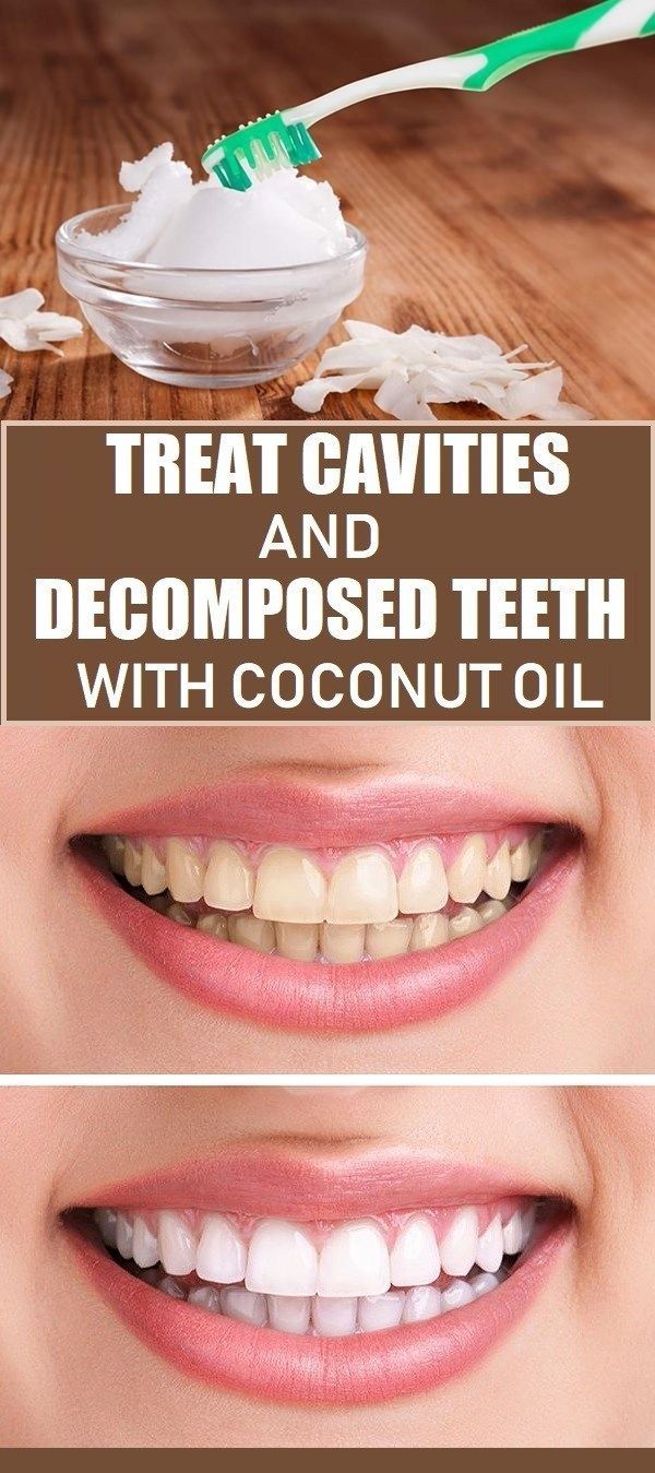 Treat Cavities and Decomposed Teeth with Coconut Oil! -   10 fitness coconut oil ideas