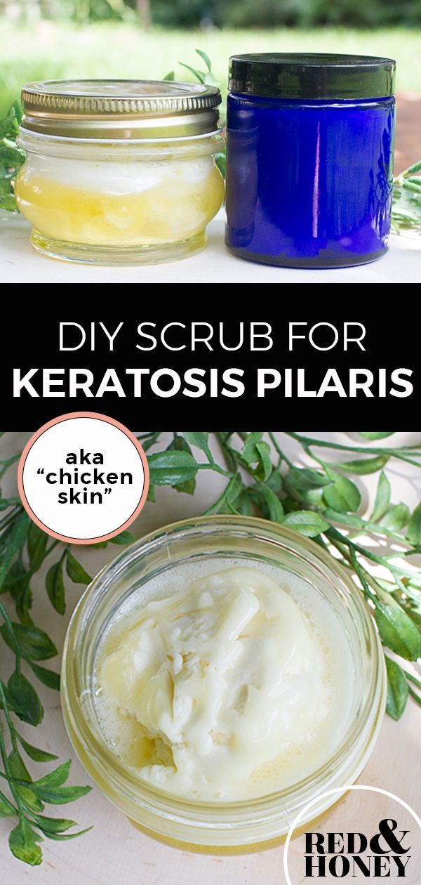 DIY Scrub and Lotion for Keratosis Pilaris (“Chicken Skin”) -   11 skin care DIY redness ideas