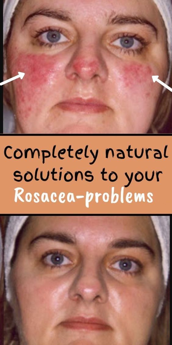 Completely natural solutions to your Rosacea-problems. -   11 skin care DIY redness ideas