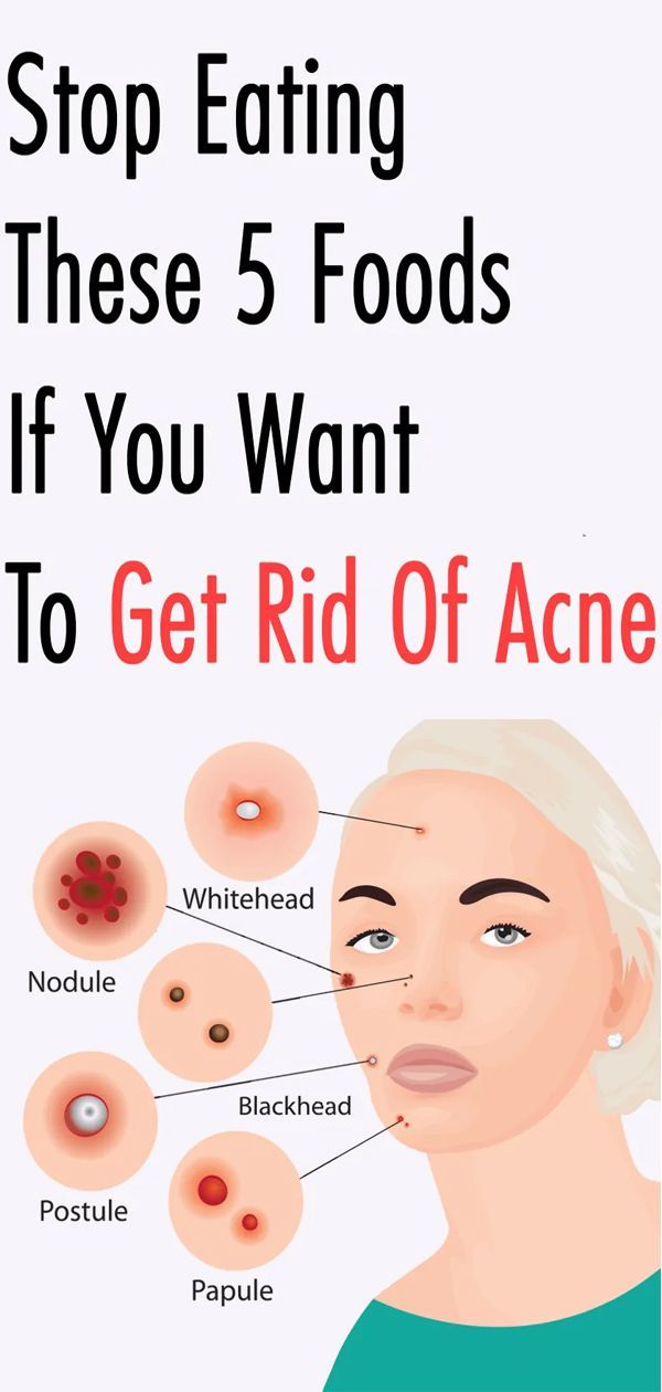 Stop Eating These 5 Foods If You Want To Get Rid Of Acne -   11 skin care Acne diet ideas