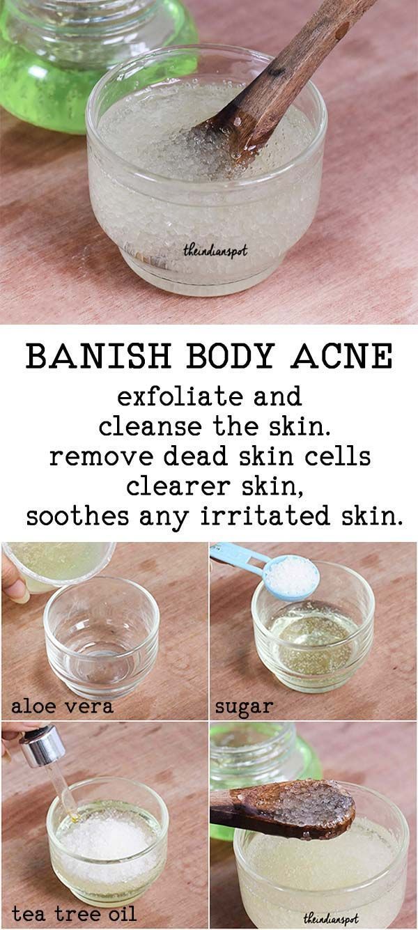 Tired Of Embarrassing Back Acne? Could You Use These Back Acne Treatment Tips? | Natural Skin Care -   14 skin care DIY scars ideas