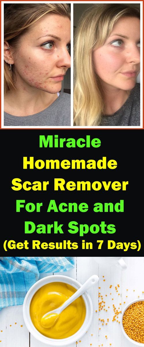 Miracle Homemade Scar Remover For Acne and Dark Spots -   14 skin care DIY scars ideas