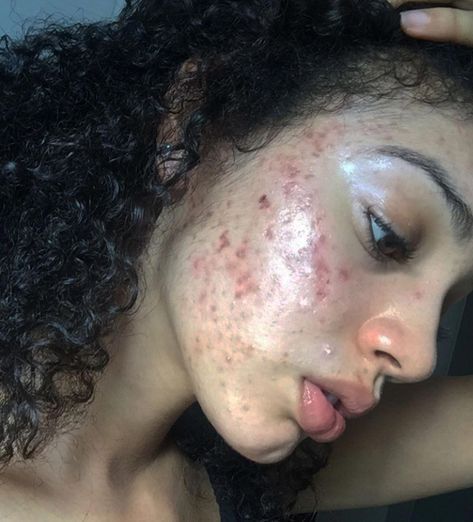 This Model's Skin Care Routine Is Going Viral After It Completely Cured Her Acne -   8 skin care Model comment ideas