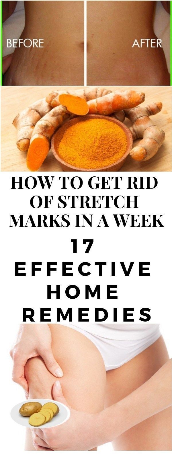 HOW TO GET RID OF STRETCH MARKS IN A WEEK -   9 skin care Beauty how to get ideas