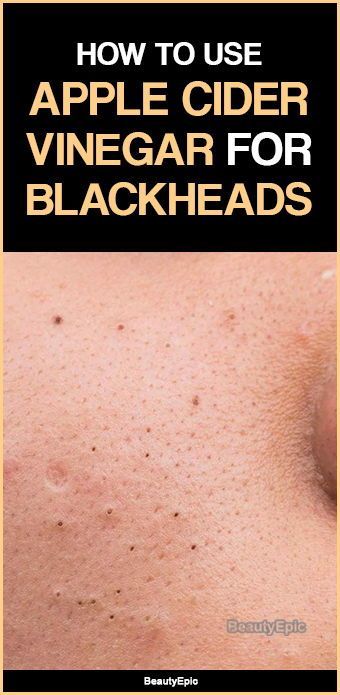 How to Remove Blackheads with Apple Cider Vinegar? -   13 skin care Blackheads apple cider vinegar ideas