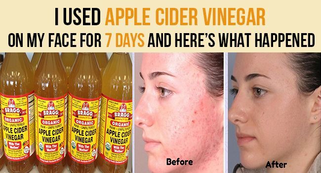I Used Apple Cider Vinegar On My Face For 7 Days And Here's What Happened - Remedies Lore -   13 skin care Blackheads apple cider vinegar ideas