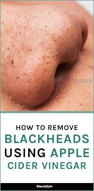 How to Remove Blackheads with Apple Cider Vinegar? -   13 skin care Blackheads apple cider vinegar ideas