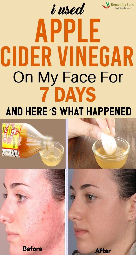 I Used Apple Cider Vinegar On My Face For 7 Days And Here's What Happened - Remedies Lore -   13 skin care Blackheads apple cider vinegar ideas
